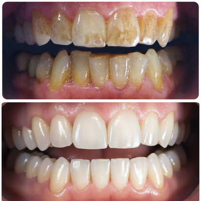 Clyn PureSmile (Teeth Whitening Powder)